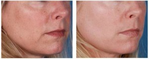 Before & After photo. Ossential Growth Factor Serum Plus was used over a 4 month duration at night.
